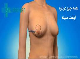 فیلم جراحی لیفت سینه یا ماستوپکسی فیلم جراحی لیفت سینه یا ماستوپکسی
