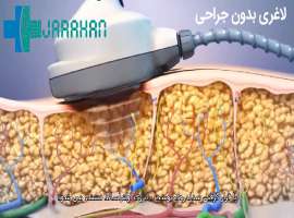 پیکرتراشی و لاغری بدون جراحی پیکرتراشی و لاغری بدون جراحی