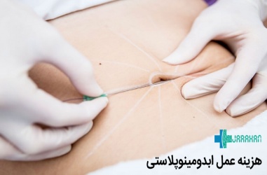 قیمت عمل ابدومینوپلاستی در تهران در سال 1399