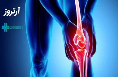 بیماری آرتروز چیست و راههای پیشگیری از آن کدامند؟