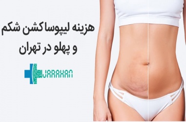 هزینه جراحی لیپوساکشن شکم و پهلو در تهران