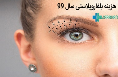 هزینه عمل افتادگی پلک در سال 1404 در تهران چقدر است؟