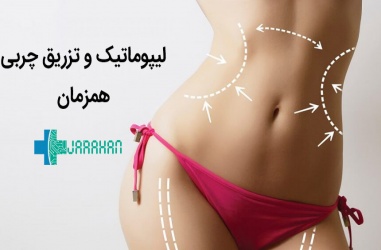 عمل لیپوماتیک و تزریق چربی همزمان در یک جلسه