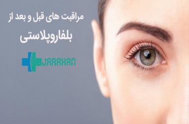 کارهایی که قبل و بعد از بلفاروپلاستی باید حتما انجام شود