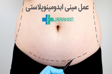 عمل مینی ابدومینوپلاستی چیست و چه کاربردی دارد؟