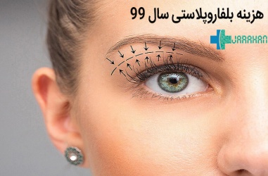 هزینه عمل افتادگی پلک در سال 99 و 1400 در تهران چقدر است؟