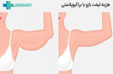 هزینه عمل لیفت بازو چقدر است؟