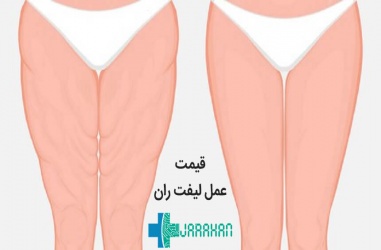 هزینه لازم برای عمل لیفت ران چقدر است؟