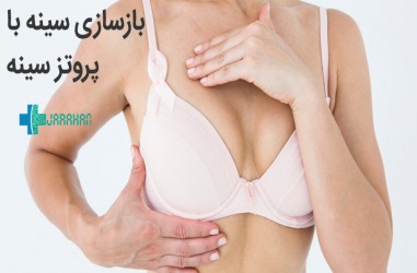 همه چیز درباره بازسازی سینه بعد از سرطان با پروتز سینه