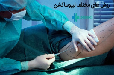 انواع روش های لیپوساکشن