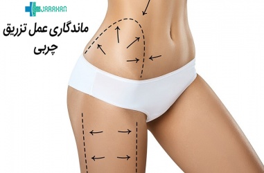 ماندگاری تزریق چربی چقدر است و چه عواملی در آن موثرند؟