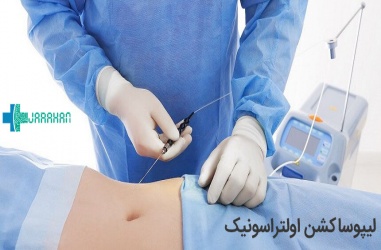 لیپوساکشن اولتراسونیک یا ویزر چیست؟