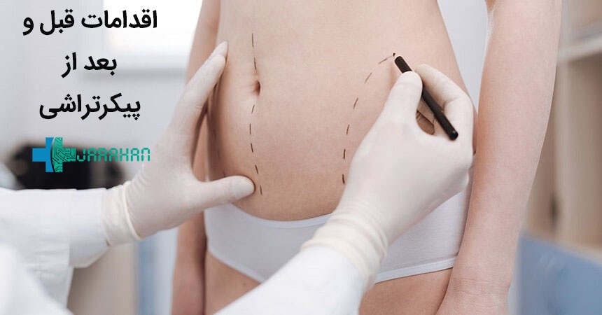اقدامات و مراقبت های قبل و بعد از عمل پیکرتراشی