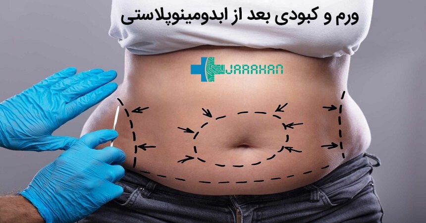 ورم و تجمع مایع بعد از ابدومینوپلاستی و آب آوردن شکم