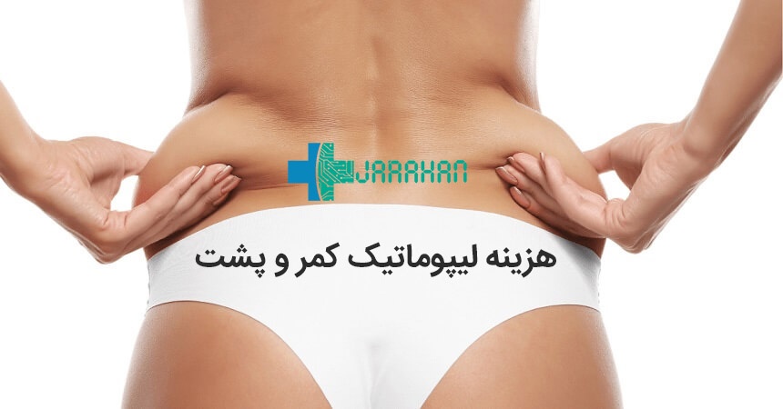هزینه عمل لیپوماتیک پشت و کمر در تهران