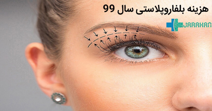 هزینه عمل افتادگی پلک در سال 99 و 1400 در تهران چقدر است؟