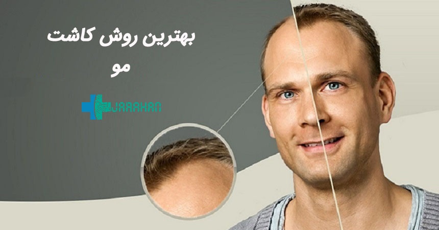 بهترین روش کاشت مو برای من کدام است؟