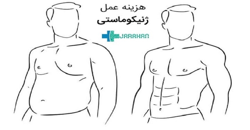 قیمت عمل ژنیکوماستی برای آقایان چقدر است؟