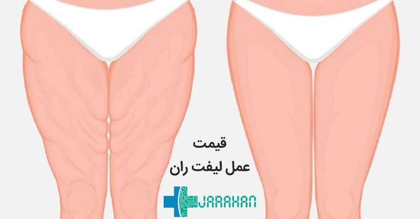 هزینه لازم برای عمل لیفت ران چقدر است؟