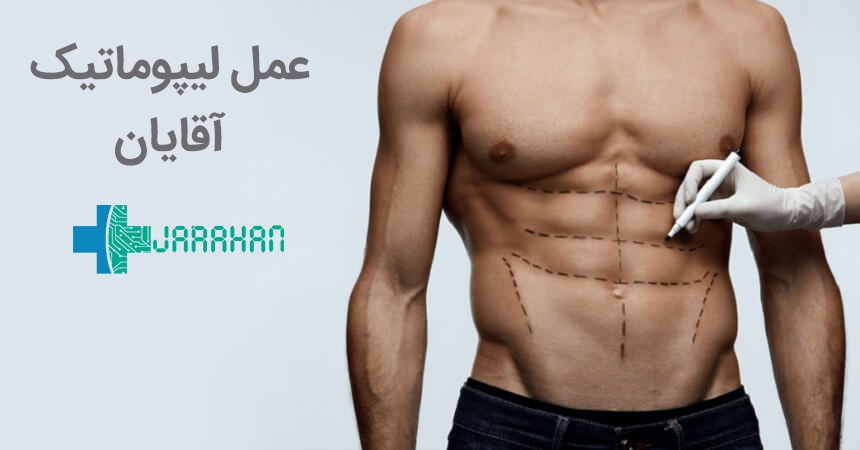 کاربرد گسترده عمل لیپوماتیک برای تناسب اندام آقایان