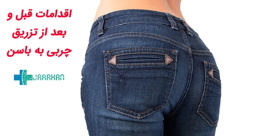 اقداماتی که قبل و بعد از تزریق چربی به باسن باید انجام شود