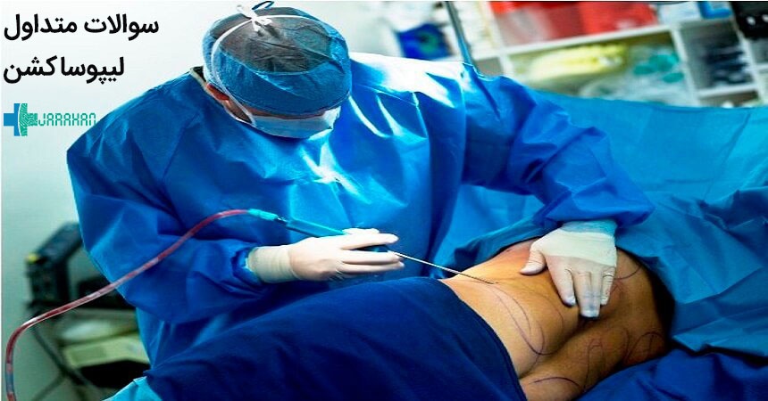 سوالات متداول در زمینه لیپوماتیک و لیپوساکشن